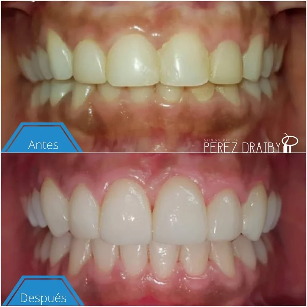 Creando Sonrisas con carillas dentales en Clínica Dental Perez Draiby, Santo Domingo, República Dominicana