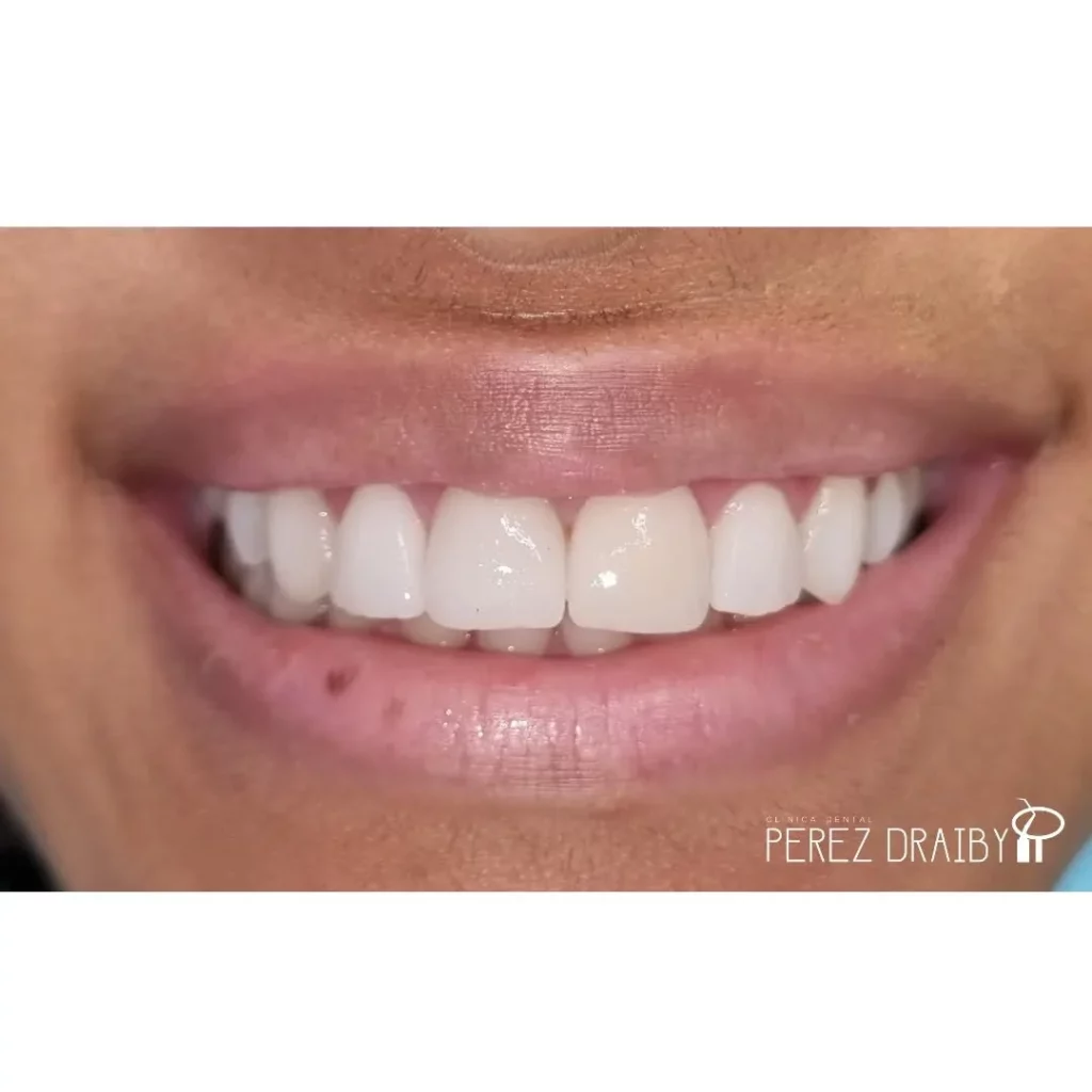 Creando Sonrisas con carillas dentales en Clínica Dental Perez Draiby, Santo Domingo, República Dominicana