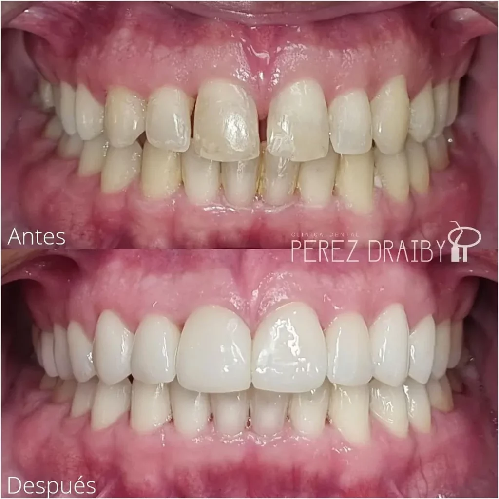 Creando Sonrisas con carillas dentales en Clínica Dental Perez Draiby, Santo Domingo, República Dominicana