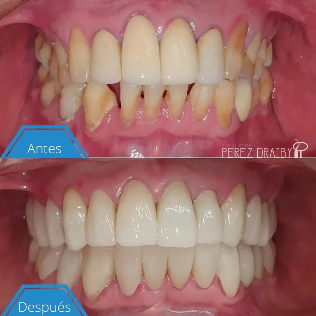 Creando Sonrisas con carillas dentales en Clínica Dental Perez Draiby, Santo Domingo, República Dominicana